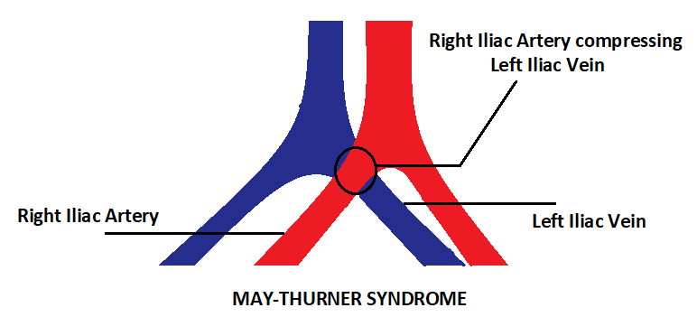 May Thurner Syndrome